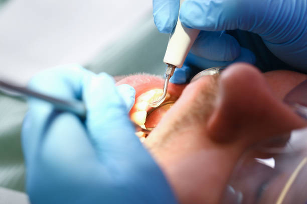 Best Emergency Tooth Extraction in Glenmoor, OH